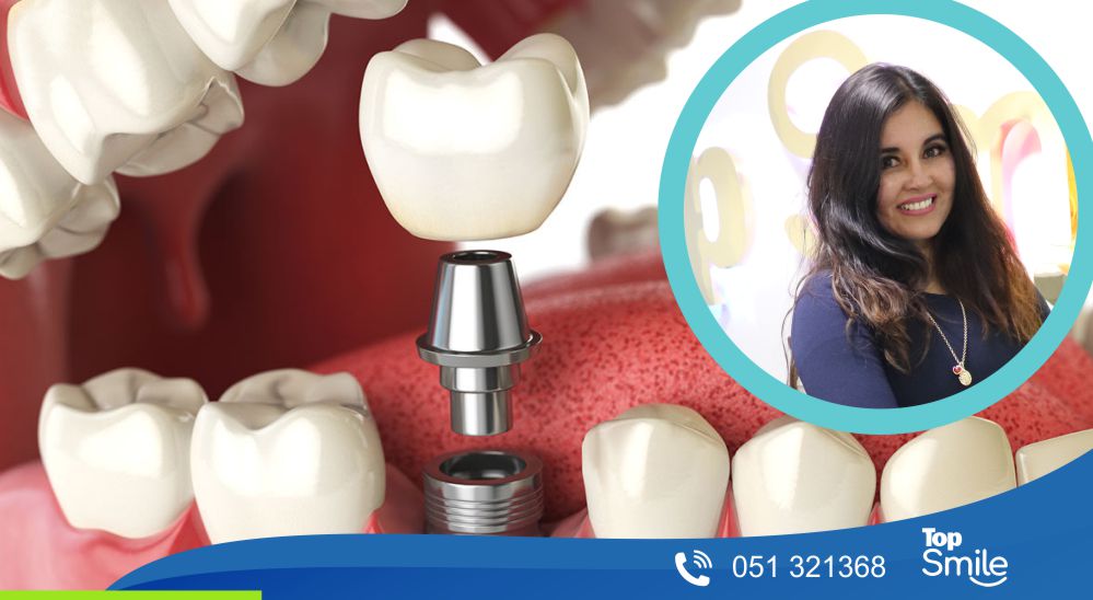 Implantes dentales