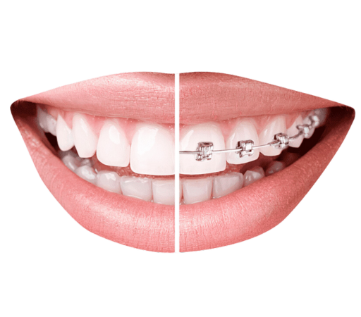 brackets