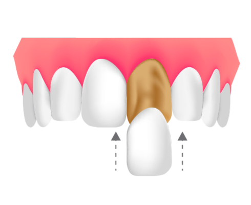 carillas dentales