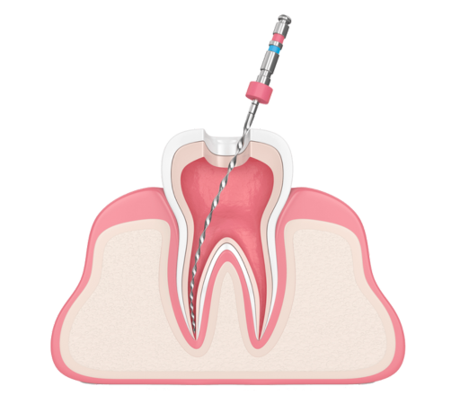 endodoncia
