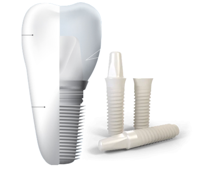 implantes
